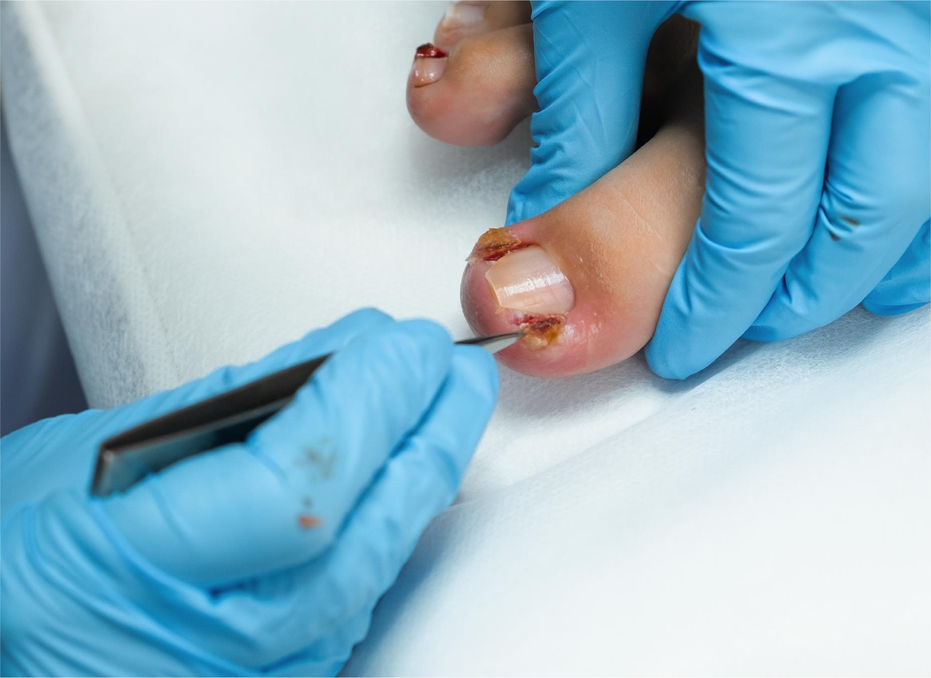 Nail Surgery