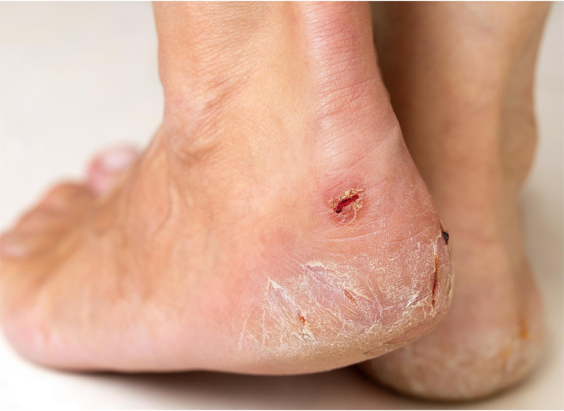 Diabetic Foot Health