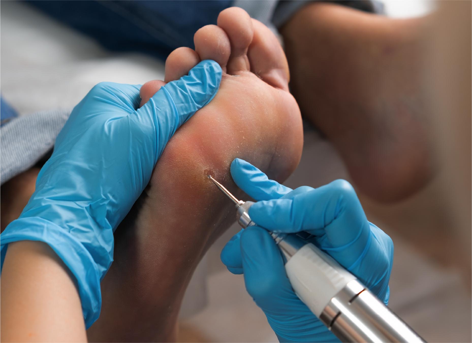Verruca Needling